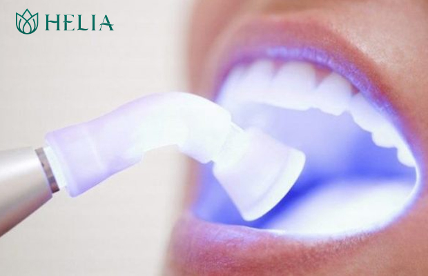 Tẩy trắng răng tại HELIA nhanh chóng - hiệu quả - lâu bền