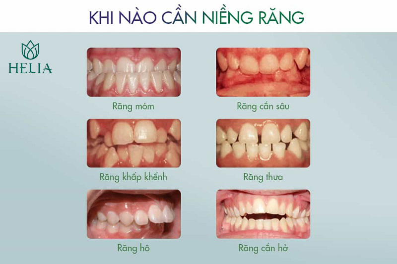 Những trường hợp cần niềng răng chỉnh nha