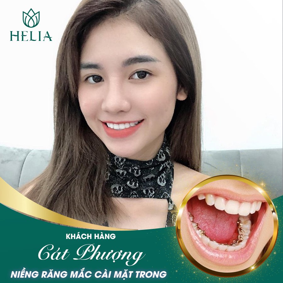 KH. CÁT PHƯỢNG - Niềng răng mắc cài mặt trong tại HELIA