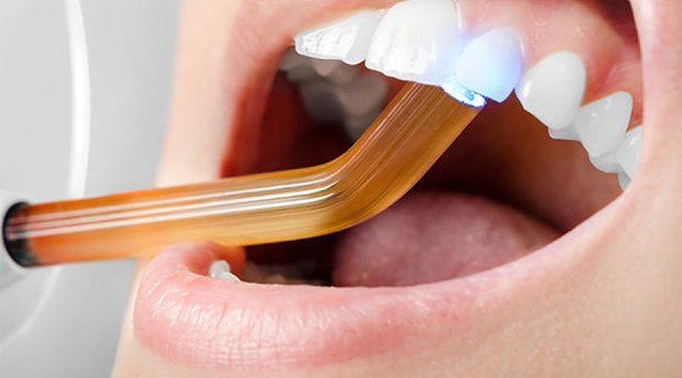 Trám răng thẩm mỹ