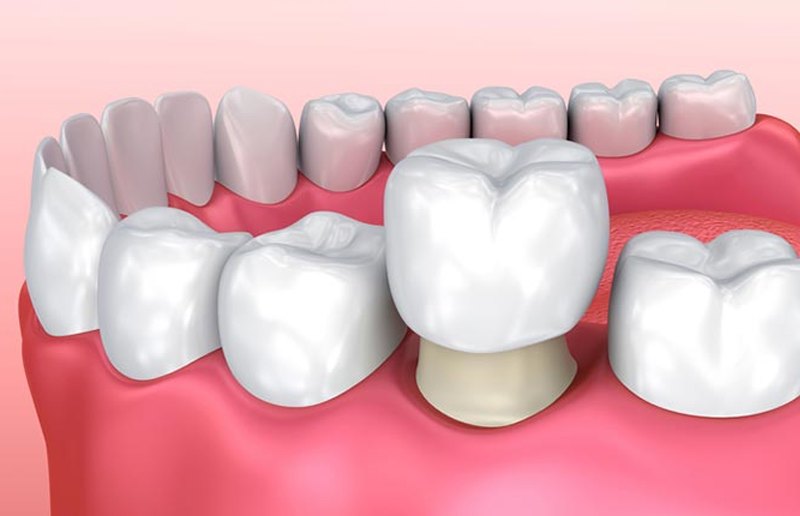 Trồng răng Implant