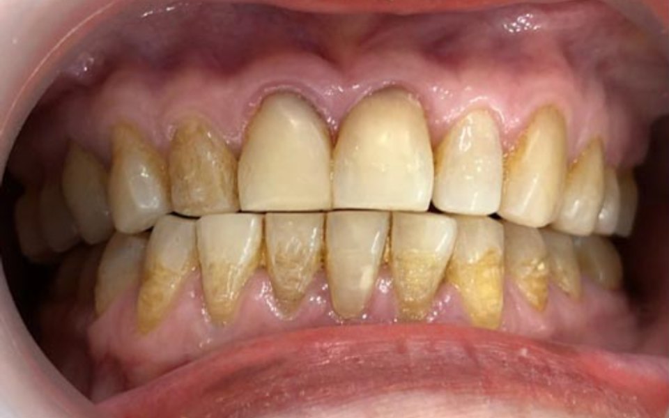 Nụ cười trước điều trị