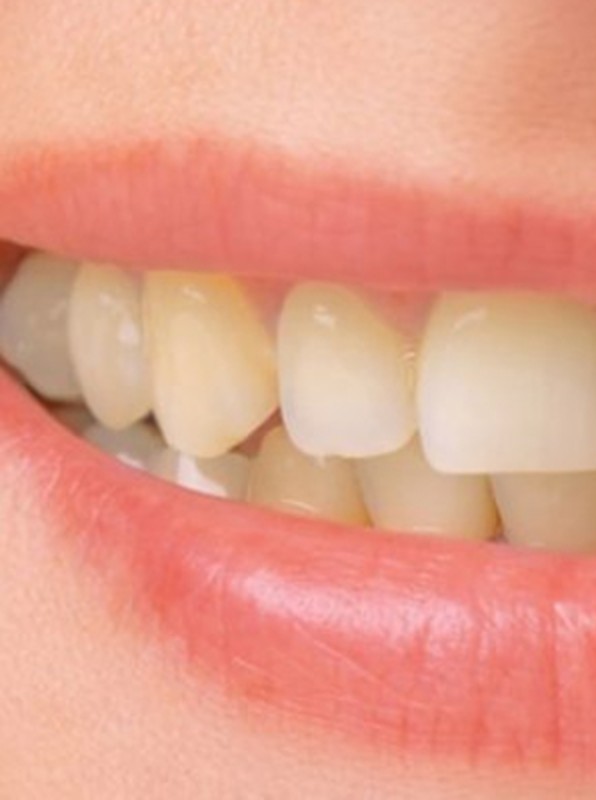 Nụ cười trước điều trị